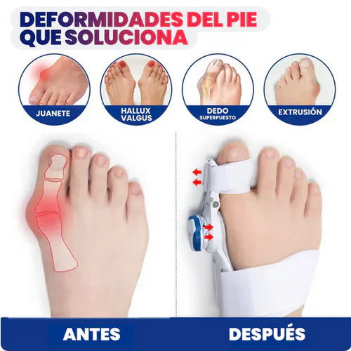 PROMO 2X1 CORRECTOR DE JUANETES - RESULTADOS EN UN MÊS + ENVÍO GRATIS ✈️